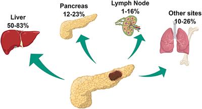 Clinical and Molecular Risk Factors for Recurrence Following Radical Surgery of Well-Differentiated Pancreatic Neuroendocrine Tumors